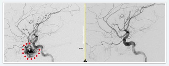 Embolization